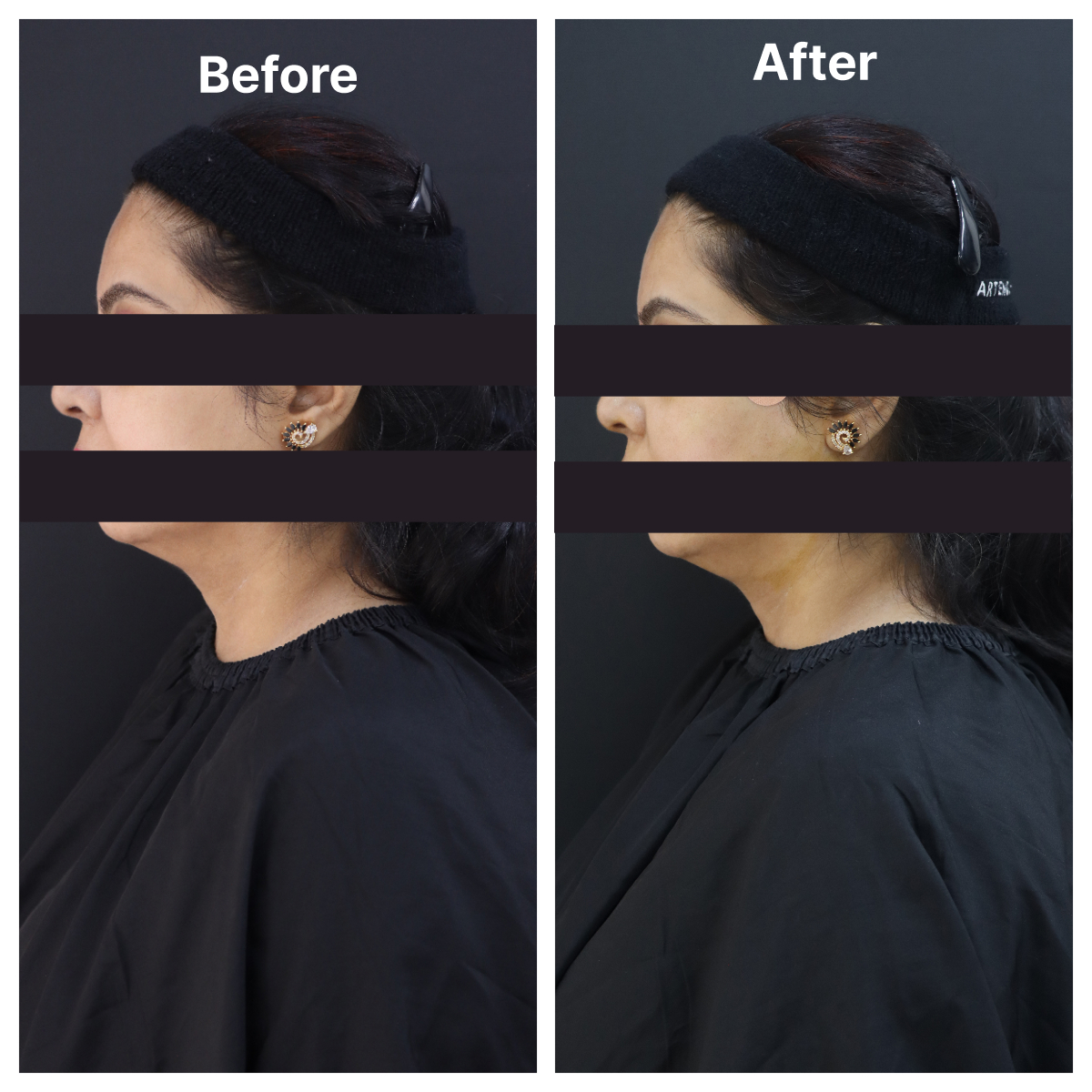 Thread Lift result KOQ10